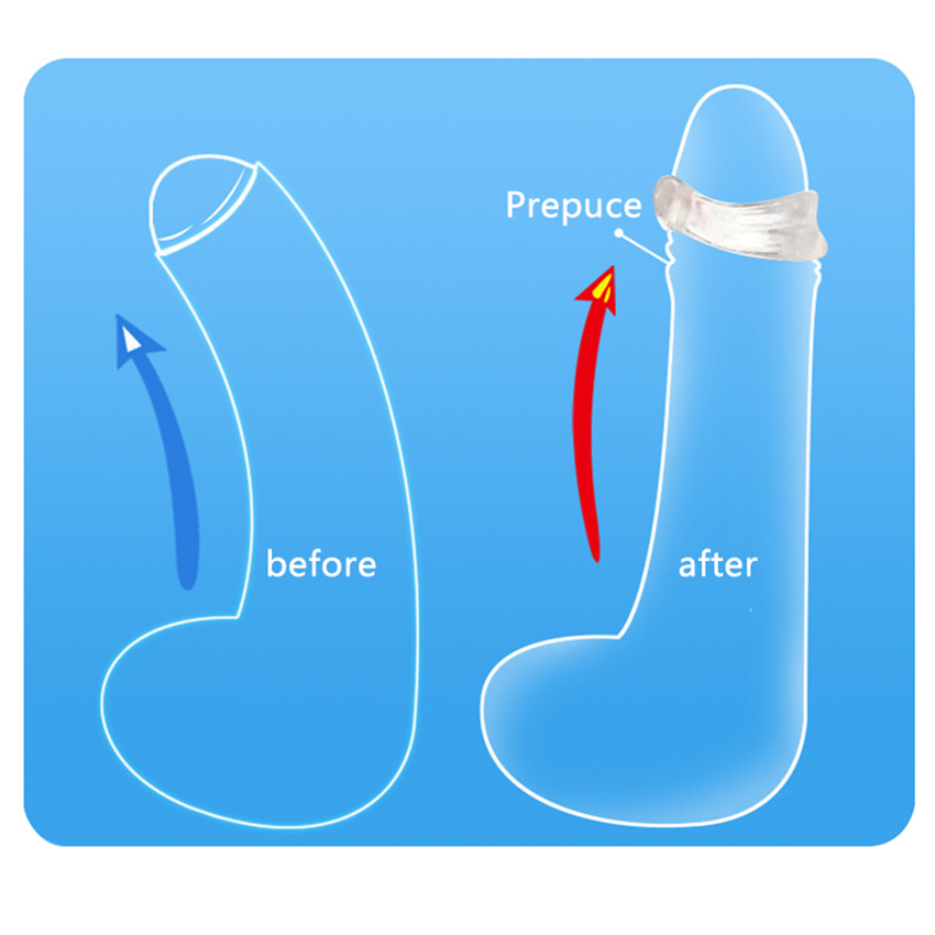 Ctype Cock Ring For Men Foreskin Correction Ejaculation Delay Resistance Training Adult Sex Toy - 3